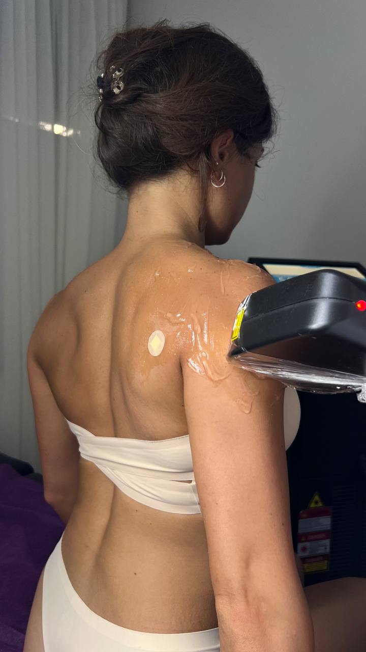 Shoulder and back laser hair removal session in progress